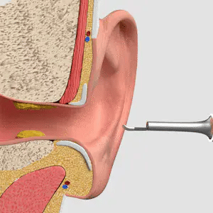 Omena - Nettoyage intelligent des oreilles grâce à une technologie de pointe